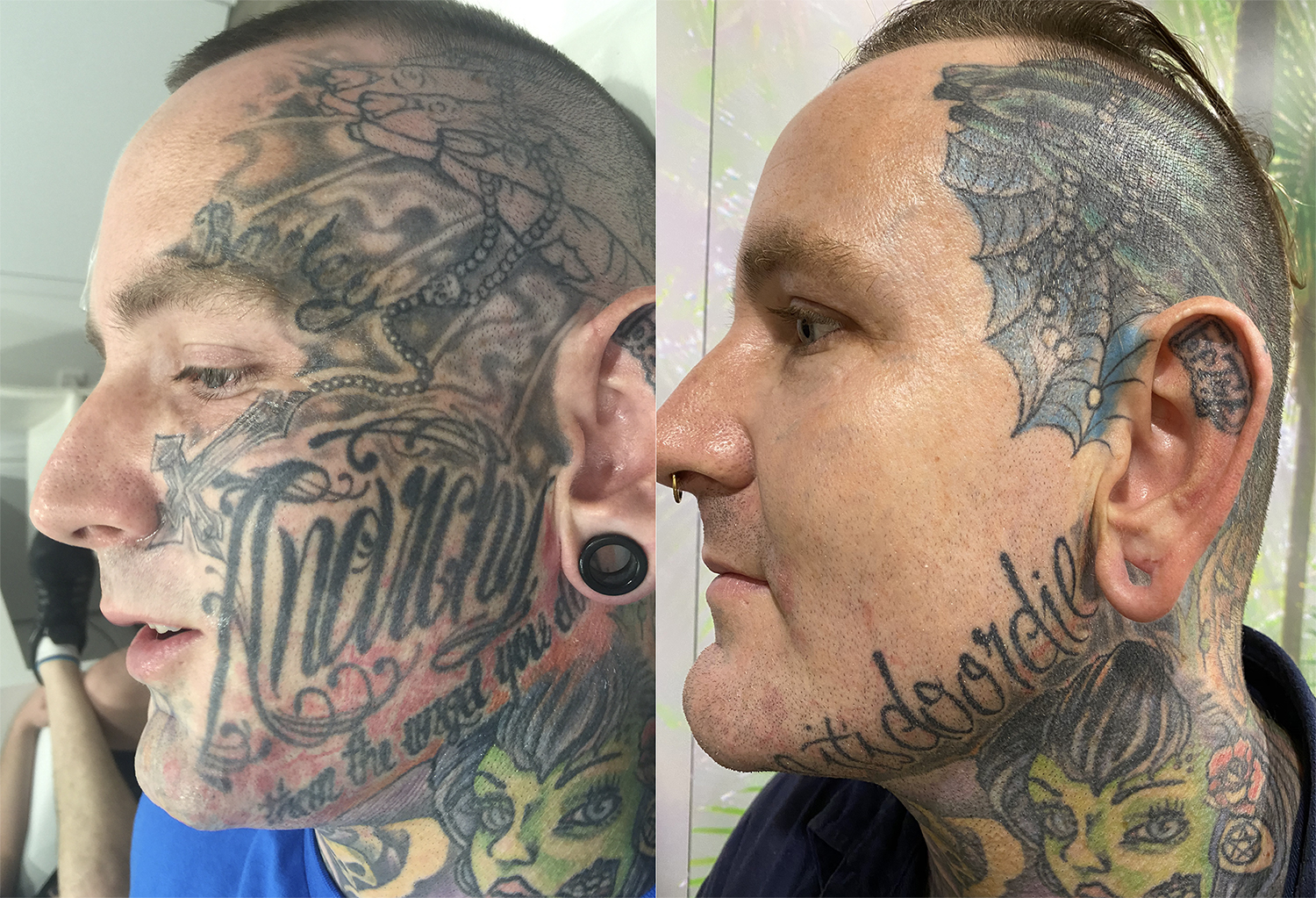 Tattoo Removal Aftercare - Stratum Clinics